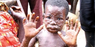 Maymun Çiçeği Hastalığı Nedir? Tedavisi Var Mı